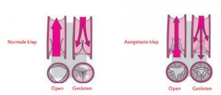 Links een gezonde klep. Rechts een beschadigde.